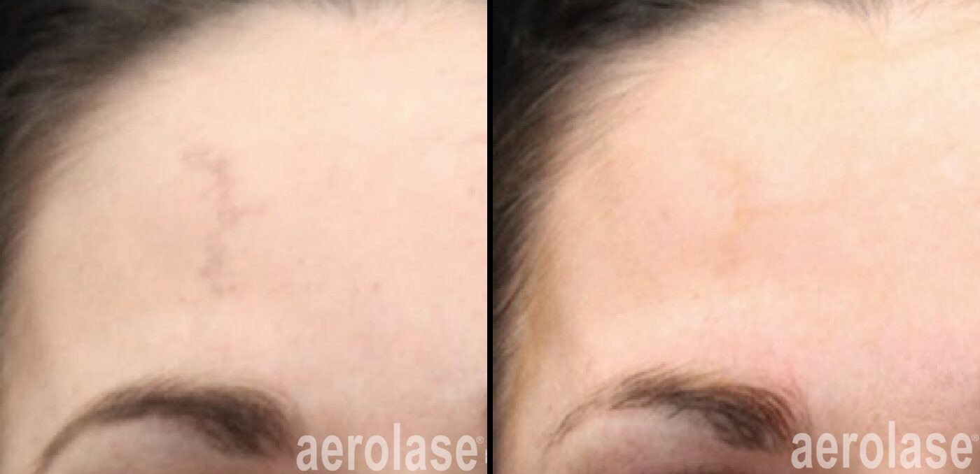 Aerolase Neo Elite forehead capillaries before and after at Haus of Wellness Bartonville TX