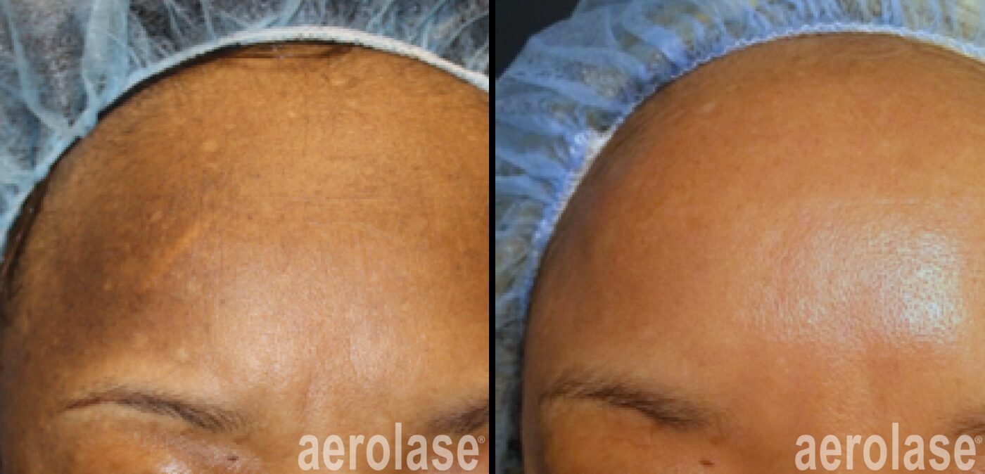 Aerolase Neo Elite melasma pigmentation before and after at Haus of Wellness Bartonville TX