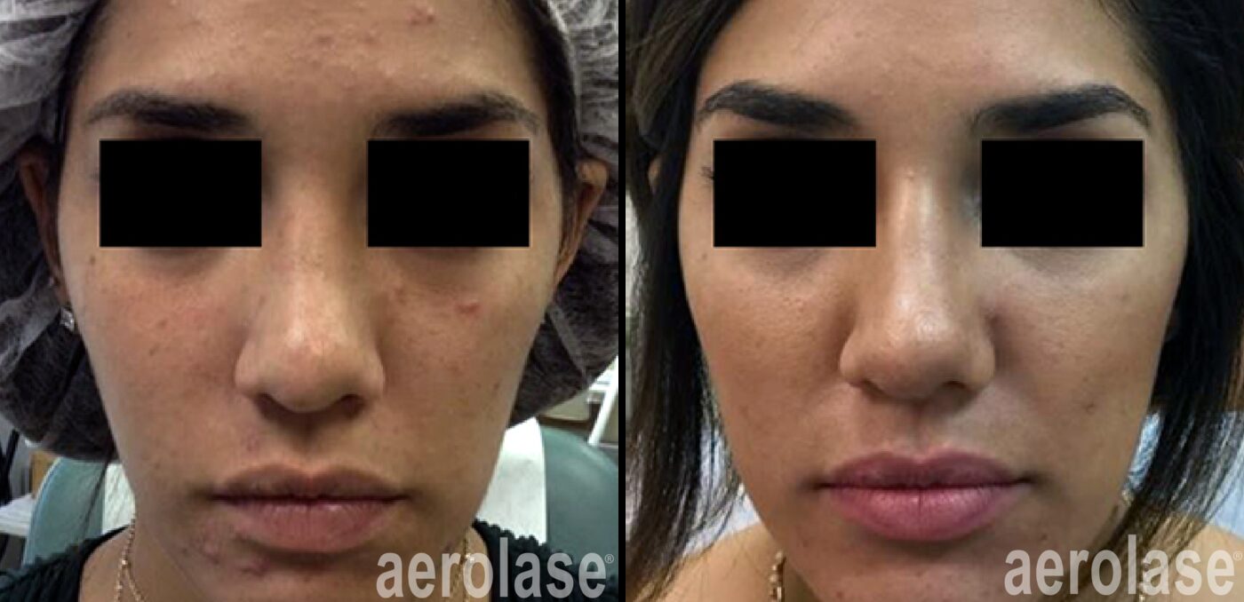 Aerolase Neo Elite acne clearance before and after at Haus of Wellness Bartonville TX