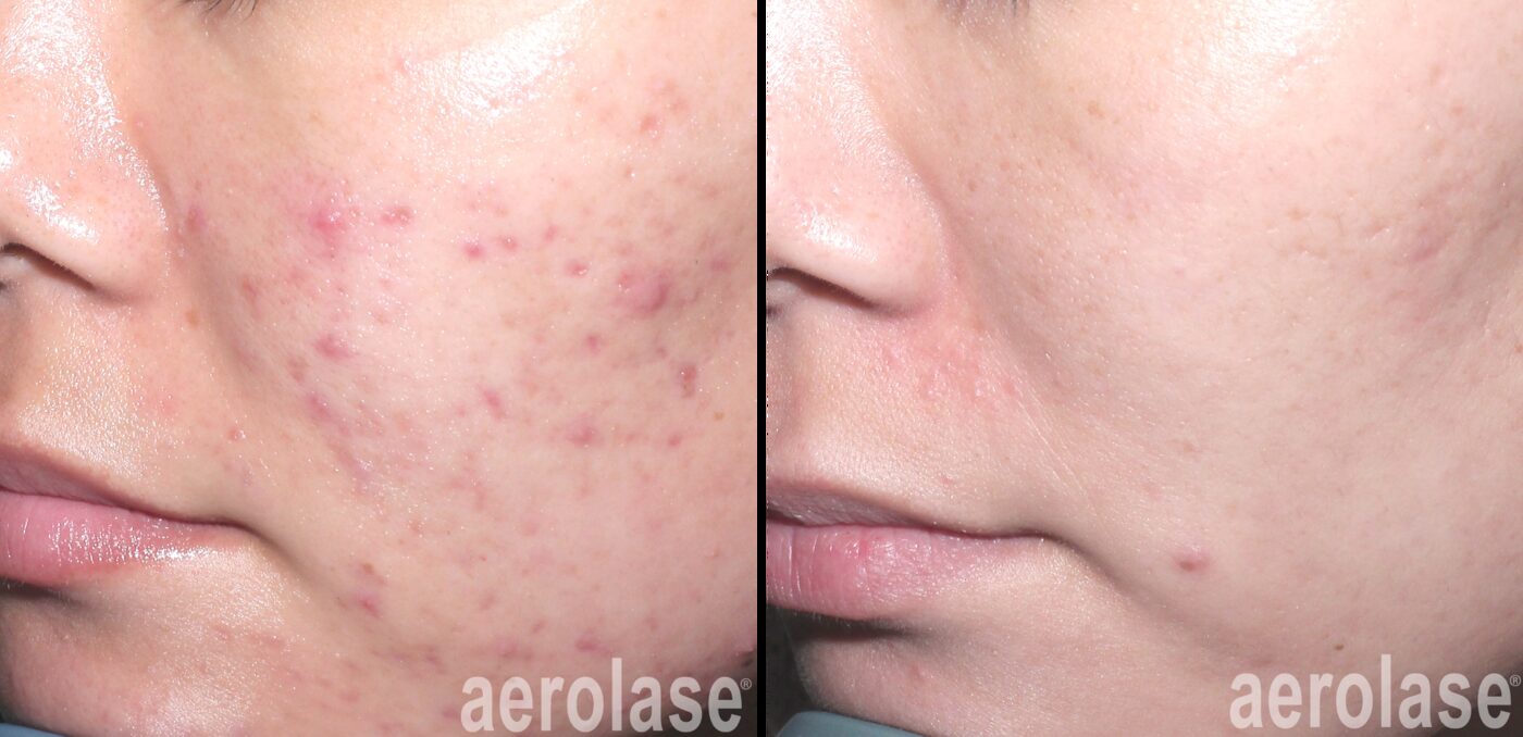 Aerolase Neo Elite acne and post-acne marks before and after at Haus of Wellness Bartonville TX