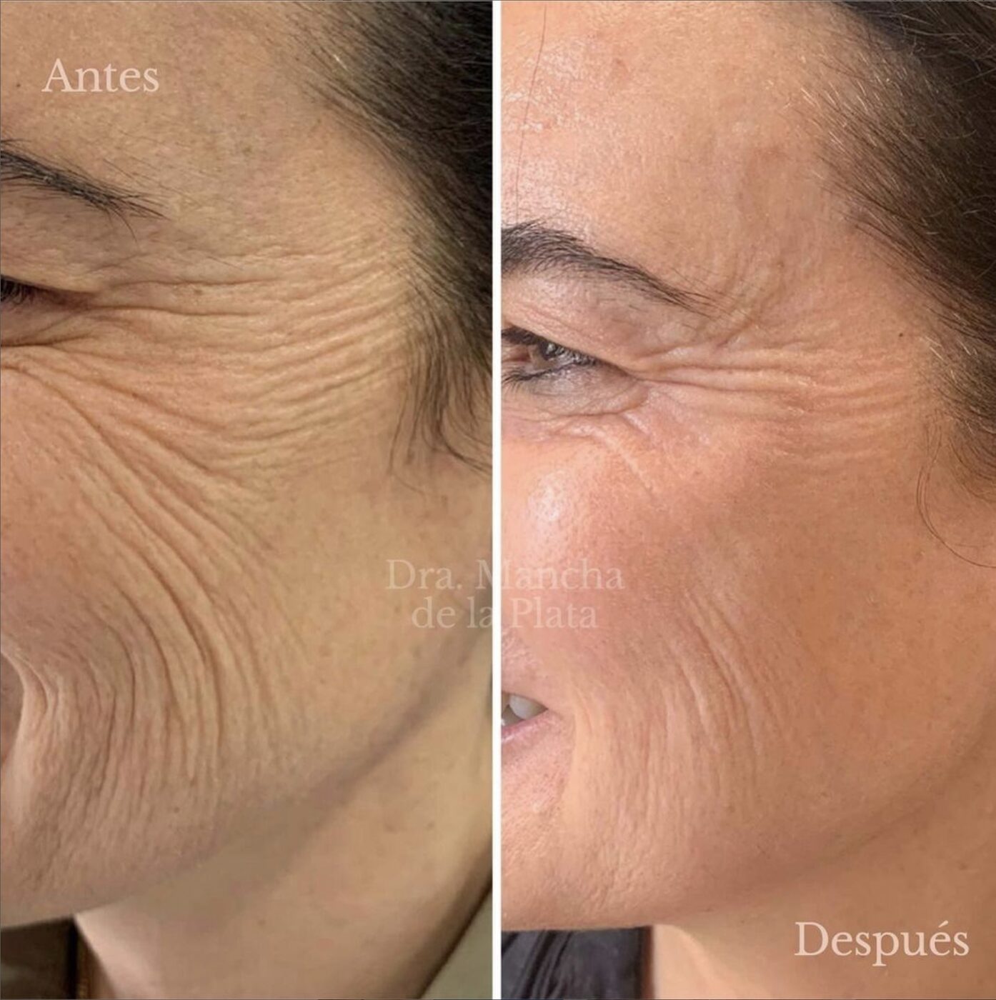 Aerolase Neo Elite NeoSkin wrinkle and skin rejuvenation before and after at Haus of Wellness Bartonville TX