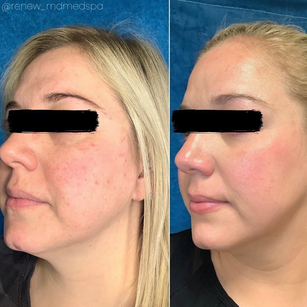 Aerolase Neo Elite NeoSkin acne and redness rejuvenation before and after at Haus of Wellness Bartonville TX