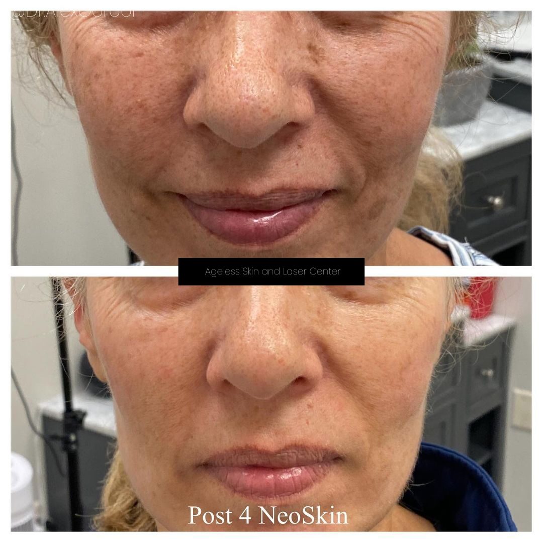 Aerolase Neo Elite NeoSkin pigmentation and melasma rejuvenation before and after at Haus of Wellness Bartonville TX