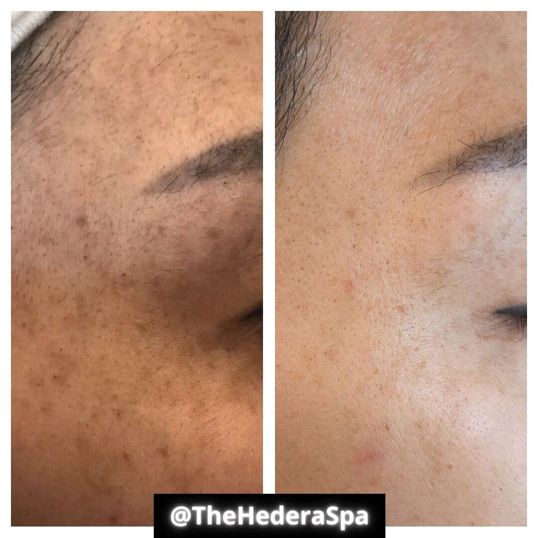 Aerolase Neo Elite forehead pigmentation and freckle clearance before and after at Haus of Wellness Bartonville TX