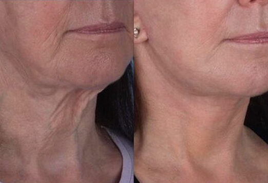 Aerolase Reverse Protocol jawline and neck tightening before and after at Haus of Wellness Bartonville TX